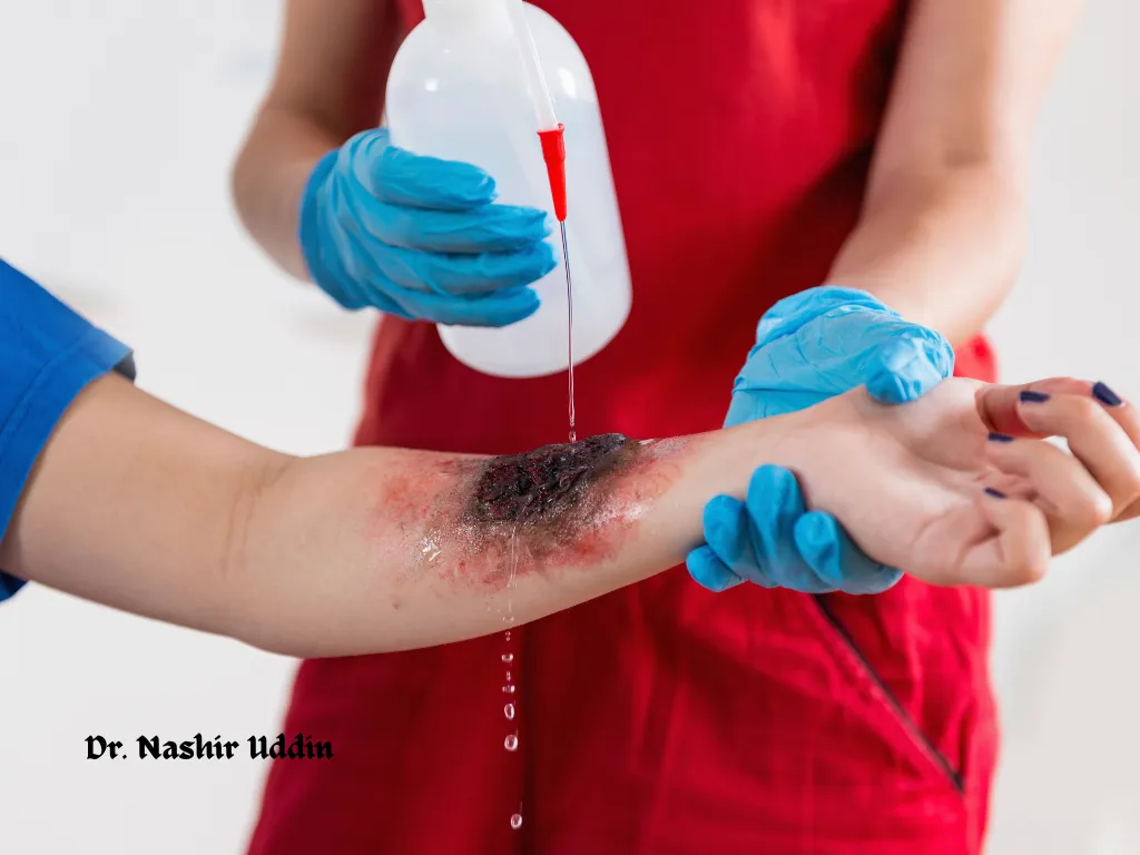 Treatment for fire burns, chemical burns, and electrical burns