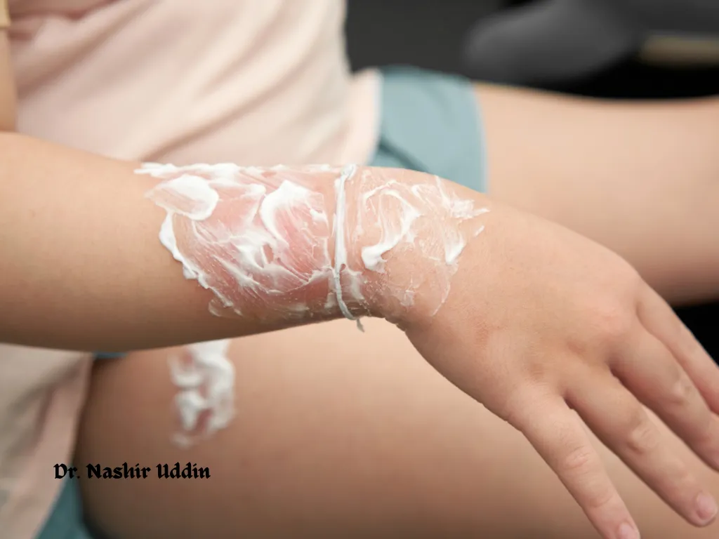 Skin grafting for burn wounds