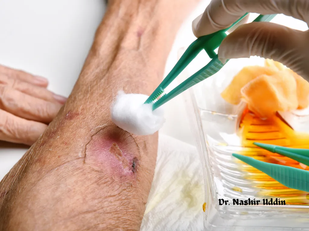Treatment for non-healing or complex wounds