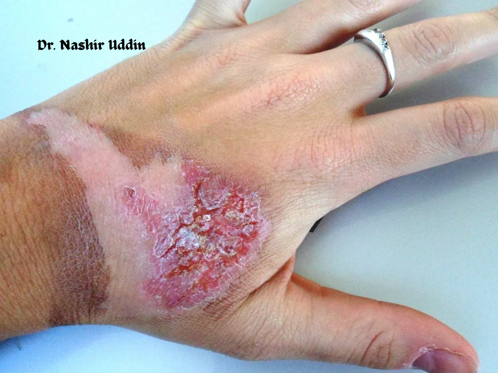 Correction of burn scars