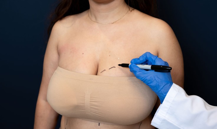 Exploring Breast Surgery: What You Need to Know