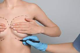 Navigating the Two Worlds of Breast Surgery: Cosmetic vs. Cancer Treatment